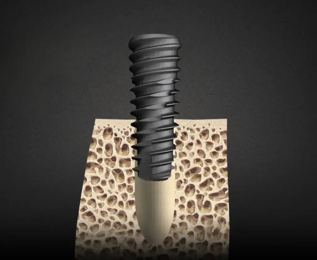 SQ Implant